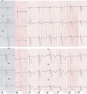 Electrocardiograms (ECG) (leads V1–V6) showing repolarization changes in spite of left bundle branch block: (A) previous ECG; (B) ambulance ECG, with chest pain; (C) admission ECG; (D) ECG six hours after admission; (E) 48 hours after admission; (F) ECG at discharge; (G) follow-up ECG two months later; (H) follow-up ECG 16 months later.