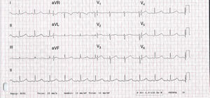 ECG de 12 derivações mostra ritmo sinusal e prolongamento significativo do intervalo QTc (cerca de 565ms).