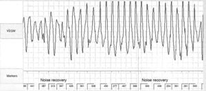 Taquicardia ventricular polimórfica detetada no registador de eventos implantável.