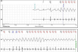 Eletrograma intracardíaco do CDI mostrando taquicardia ventricular polimórfica, detetada por monitorização remota.