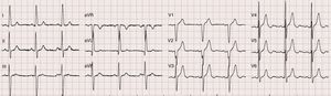 Eletrocardiograma: ritmo sinusal, FC 75bpm, critérios de voltagem de hipertrofia ventricular esquerda, sem sobrecarga.