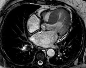RM cardíaca: hipertrofia acentuada do SIV basal e médio (22mm); aurícula esquerda moderadamente dilatada (área 33cm2).