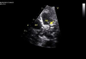 Ecocardiografia transtorácica, plano paraesternal eixo curto: origem da artéria coronária esquerda (seta) a partir do tronco da artéria pulmonar (ap). Aorta (ao).