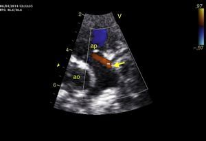 Ecocardiografia transtorácica, plano paraesternal: fluxo retrógrado diastólico da artéria coronária esquerda (seta) para o tronco da artéria pulmonar (ap), levando a roubo da circulação coronária. Aorta (ao).