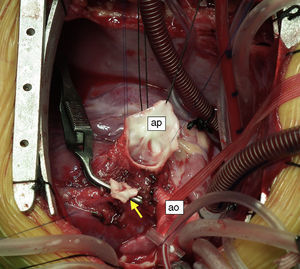 Fotografia intraoperatória: artéria pulmonar (ap) e artéria coronária esquerda (seta) abertas. Aorta ascendente (ao).