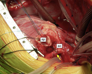 Fotografia intraoperatória: artéria coronária esquerda (seta) anastomosada à aorta ascendente (ao), vendo‐se a artéria pulmonar (ap) aberta.
