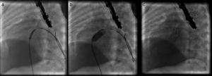 Angiographic images: (a) stent positioning at the level of the interatrial septum; (b) stent expansion; (c) fully expanded stent.