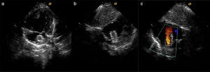 Transthoracic echocardiography of a patient with hypoplastic left heart syndrome after stent implantation into the interatrial septum. (a and b) Two-dimensional image; (c) color Doppler imaging of the flow through the implanted stent.