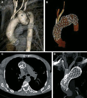 Pre-procedure computed tomography angiography (CTA) showing a large aneurysm in the distal aortic arch involving the origin of the left subclavian artery (A). Follow-up CTA at one month revealed no endoleak and patency of the innominate and LCCA stent grafts (B, C, D).
