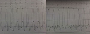 Cateterismo: curva hemodinâmica a demonstrar pressões dos ventrículos com sinal dip and plateau; curva direita com descida Y pronunciada.