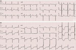 Eletrocardiograma: A) basal; B) durante episódio de dor torácica, evidenciando infradesnivelamento de ST difuso com máximo de 7mm na derivação V4.