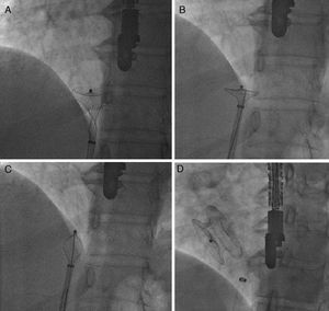 Concave deformation of the distal left atrial (LA) disc preventing full device recapture (A); the stiff and flat side of a 0.038” J-wire guided through the sheath to the LA disc (B); concave deformity rectified by engaging the hub section, and the device completely retracted into the sheath (C); final position of the 26 mm Cera device after implantation (D).