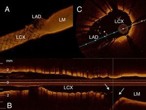 (A–C) Pullback from the left circumflex (LCx) with 3D reconstruction. V-stenting with both stents protruding slightly into the left main (LM). Arrows: stent in the left anterior descending artery (LAD); *: neo-carina.