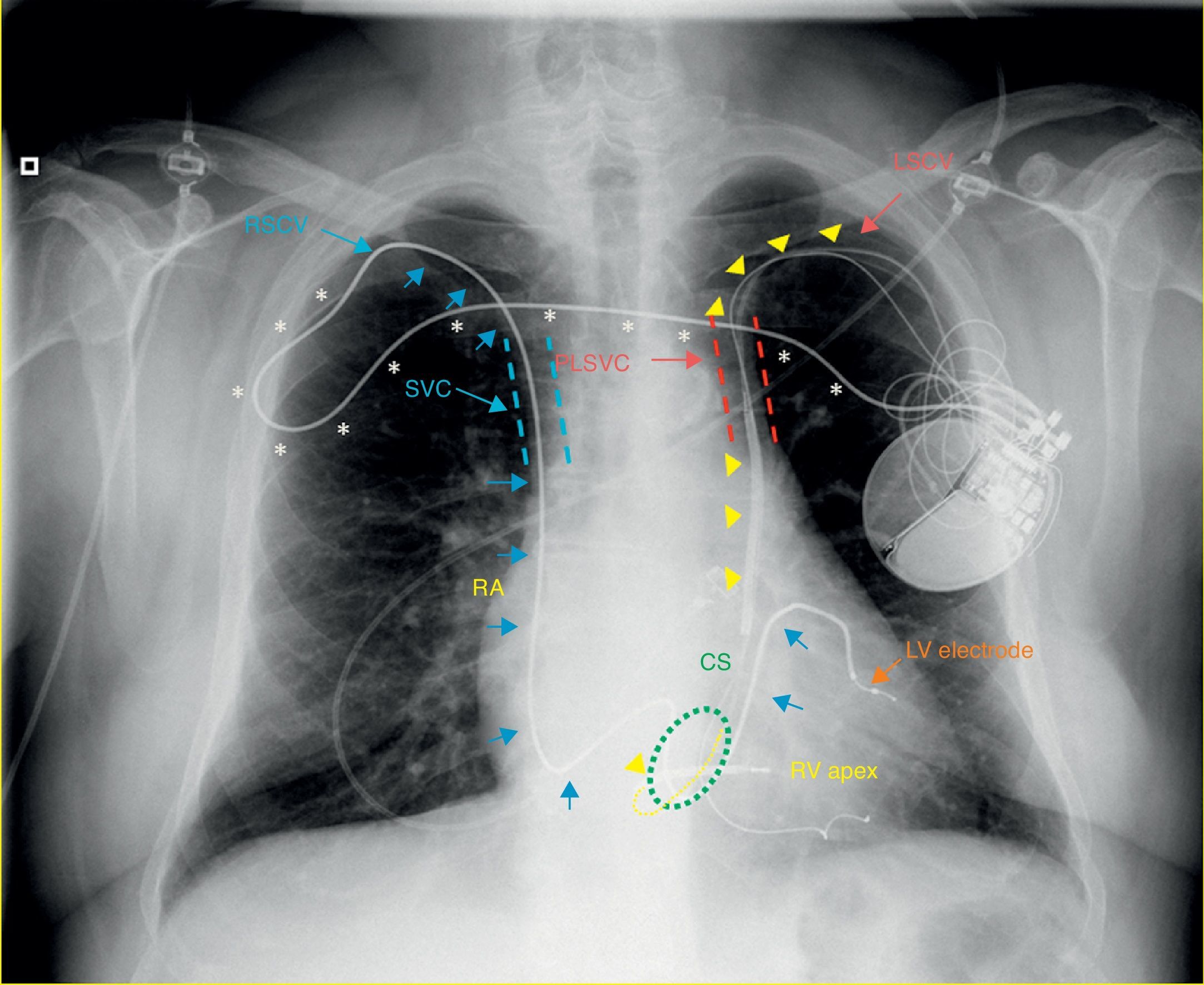 Left to right and right to left | Revista Portuguesa de Cardiologia