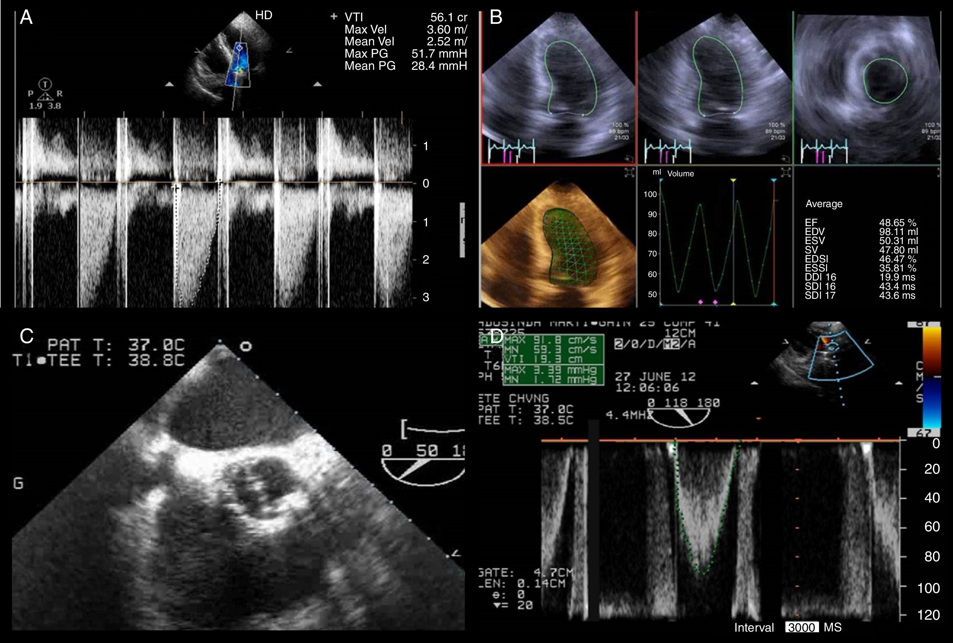 A 75-year-old woman with chest pain and transient severe left ...