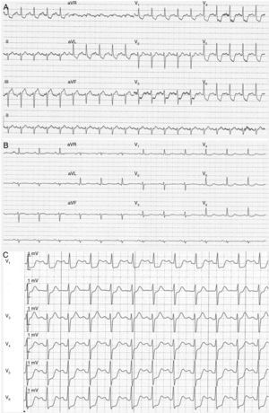 (A–C) Electrocardiography. A 12-lead electrocardiogram obtained six hours after onset of chest pressure revealed normal sinus rhythm with widespread ST-segment depression (1–2 mm in leads V2 to V6, DI and aVl, DII–III and aVF) (A); the chest pain and ST-segment depression resolved (B); the patient was readmitted with recurrence of chest pain and marked ST depression in all precordial leads (C).