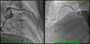 Coronary angiography. A 40% luminal stenosis with no evidence of plaque rupture or thrombus was observed in the left anterior descending artery. The circumflex and right coronary arteries were normal.