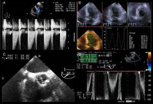 (A–D) Echocardiography. Transthoracic echocardiogram performed after pain relief showed mean gradient between the aortic and left ventricular systolic pressures of 26 mmHg (A) and slightly impaired left ventricular systolic function with left ventricular ejection fraction of 49% using the three-dimensional Simpson's method (B); transesophageal echocardiography allowed better characterization of the mechanical aortic prosthesis, excluding valve dysfunction (C and D).