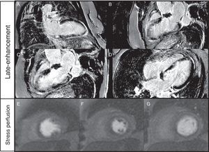 (A–G) Cardiac magnetic resonance imaging. Late-enhancement gadolinium evaluation showed transmural infarct scar in the inferoseptal wall and subendocardial infarct in the inferior and inferolateral walls (A–D). Ischemia (reversible perfusion defect) was documented in the mid-basal segments of the anterior and anterolateral walls (E–G).