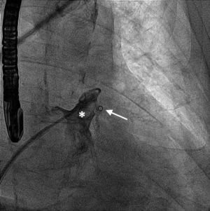 Selective angiography of the left atrial appendage using a pigtail catheter shows the relationship between this structure (asterisk) and the stents previously implanted in the mid-circumflex artery (arrow).