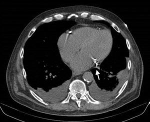 Thoracic computed tomography performed after an episode of alveolar hemorrhage also reveal the proximity of the circumflex artery to the left atrium and left atrial appendage (arrow).