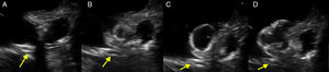 Intraoperative monitoring of deployment of the Amplatzer device by transesophageal echocardiography (A–D). Stents previously placed in the circumflex artery (yellow arrows) can be seen in the vicinity of the left atrial appendage, immediately next to the device landing zone.