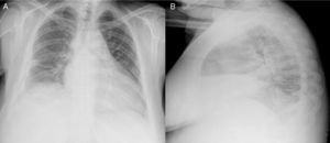 Chest radiograph.