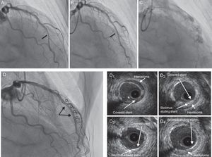 (A) Coronary angiography (right anterior oblique view) showing a severe lesion in the mid left anterior descending artery (arrow); (B) underexpanded biolimus-eluting stent (arrow); (C) coronary artery perforation after postdilation with non-compliant balloon; (D) coronary angiography after hemodynamic stabilization showing probable underexpansion of the covered stent (arrows); (D1–4) intravascular ultrasound after postdilation with non-compliant balloon: (D1) segment with a well-expanded covered stent and hematoma outside the lumen; (D2 and 3) segment with two layers of stent (covered stent and biolimus-eluting stent); (D4) segment with a biolimus-eluting stent only.