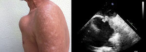 À esquerda: massa em região anterior do tórax. À direita: ecocardiografia transtorácica mostrando grande dilatação aneurismática do arco aórtico, um saco aneurismático extraluminal (pseudoaneurisma) e um estreito colo com fluxo contido por imagem compatível com trombo.