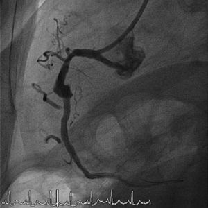 Uma semana após evento agudo é aparente imagem de trombo organizado e fluxo através da malha do stent.