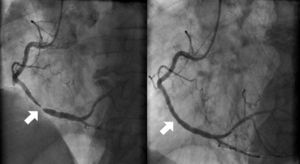 Angiography of the right coronary artery, with images before and after percutaneous coronary intervention (white arrow).