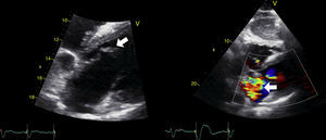 Subcostal transthoracic echocardiographic images showing anterolateral papillary muscle rupture and severe mitral regurgitation (white arrow).
