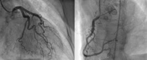 Selective coronary angiography. Left (left) and right (right) coronary arteries, showing absence of coronary artery disease.