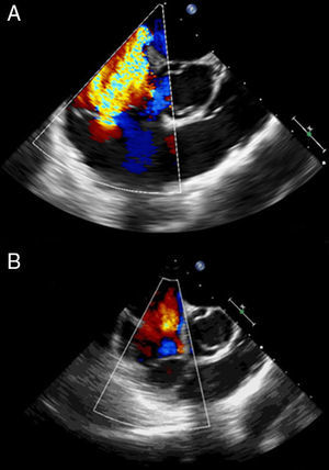 Mid-esophageal right ventricular inflow-outflow view before (A, with right ventricular dilatation and severe tricuspid regurgitation) and after percutaneous thrombectomy (B, with normal size right ventricle and resolution of tricuspid regurgitation).