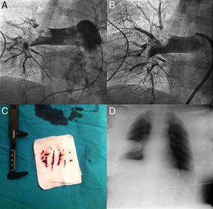 Pre- (A) and post-intervention (B) angiography of the right pulmonary artery. Abundant thrombotic material was retrieved (C). Chest radiograph (D) showed wedge-shaped pleural based opacities (“Hampton's hump”).