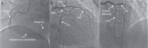 Preoperative coronary angiography showing (A) the RCA in left oblique projection, (B) the left coronary system in right caudal projection, and (C) the left coronary system in anterior cranial projection. Cx: circumflex artery; LAD: left anterior descending artery; RCA: right coronary artery.