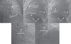 Postoperative coronary angiography showing (A) left internal mammary artery-diagonal artery graft in anterior projection; (B and C) aorta-RCA saphenous vein graft, native RCA and ICC between RCA and Cx in left oblique projection; (D) the stent on anterior caudal projection; and (E) post-stenting LAD in right cranial projection. Cx: circumflex artery; ICC: intercoronary communication; LAD: left anterior descending artery; LIMA: left internal mammary artery; RCA: right coronary artery.