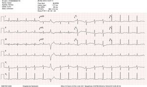 ECG na admissão que mostrava uma taquicardia sinusal, com baixa voltagem nas derivações dos membros e alterações inespecíficas de repolarização ventricular.