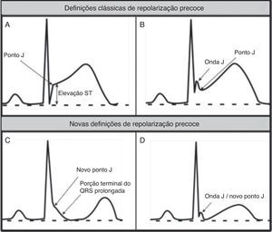 Definição clássica de RP versus novas definições de RP. (A e B) Definição clássica de repolarização precoce baseada na elevação ST no final do QRS (ponto J); exemplos sem (A) e com (B) onda J. (C e D) Novas definições de repolarização precoce com porção terminal do QRS prolongada e novo ponto J (C); sem elevação ST (D).