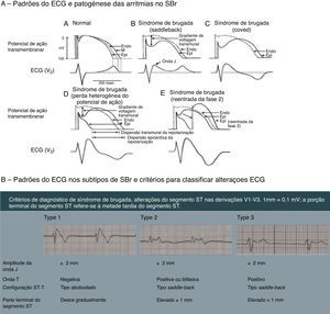 A ‐ Representação das alterações do potencial de ação epicárdico do ventrículo direito propostas como a base das manifestações eletrocardiográficas da síndrome de Brugada. 7B ‐ Os três tipos de padrões eletrocardiográficos associados à <span class=