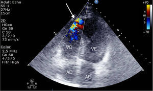 Ecocardiograma transtorácico a evidenciar fluxo turbulento apical (seta) devido à presença de rotura do septo interventricular (velocidades máximas registadas pelo Doppler contínuo inferiores a 3m/s). AD: aurícula direita; AE: aurícula esquerda; VE: ventrículo esquerdo; VD: ventrículo direito.