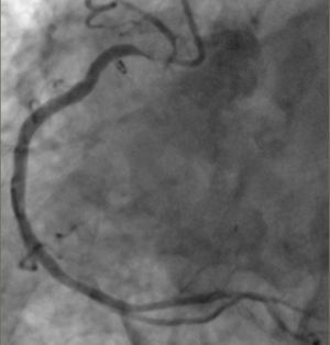 Diagnostic selective right coronary artery angiogram showing ostial calcified subtotal right coronary artery stenosis.