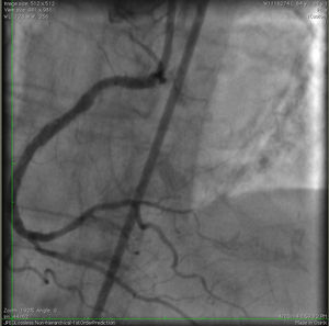 Selective right coronary artery angiogram after coronary intervention with rotational atherectomy, balloon angioplasty and stent placement.