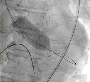 Balloon aortic valvuloplasty with a 20mm balloon.