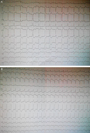 12-lead ECGs on admission and showing dynamic changes during hospitalization. (A) ECG on admission showing complete right bundle branch block, QS waves and 1–2 mm ST-segment elevation in leads II, III and aVF; (B) ECG seven hours after admission showing sinus tachycardia, complete right bundle branch block, QS waves and 4–5 mm elevation of ST-segment in leads II, III and aVF, and 0.5–3 mm ST-segment depression in leads I and V1–V5.