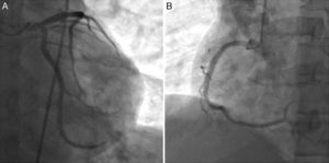 Coronary angiography showing normal left main, left descending and left circumflex coronary arteries (A) and right coronary artery (B).