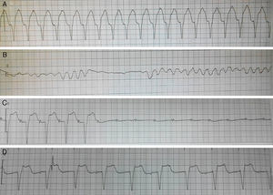 Representative ECGs (lead II) of various arrhythmias and of pacemaker recorded by the ECG monitor during hospitalization. (A) Ventricular tachycardia; (B) ventricular fibrillation; (C) high-degree atrioventricular block; (D) ventricular pacing by temporary pacemaker.