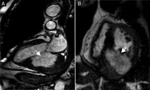 Ressonância magnética cardíaca cine‐SSFP: (A) longo eixo, a mostrar aneurisma ventricular gigante (maior eixo 6,7cm)da parede posterior (seta), com trombo no seu interior; (B) curto eixo acima do nível dos músculos papilares, a demonstrar volumoso aneurisma ventricular inferior e posterior (seta), com trombo no seu interior. SSFP: Steady‐State Free Precession.