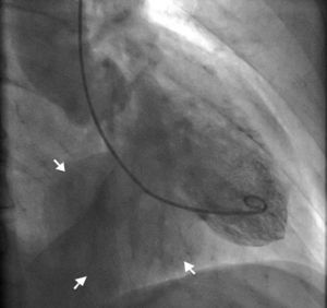 Ventriculografia a demonstrar aneurisma ventricular gigante, com setas a limitar os seus limites anatómicos.