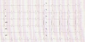Patient's electrocardiogram at age 20, documenting the appearance of complete right bundle branch block and ST-segment elevation in the right precordial leads, suggesting type 1 Brugada syndrome.